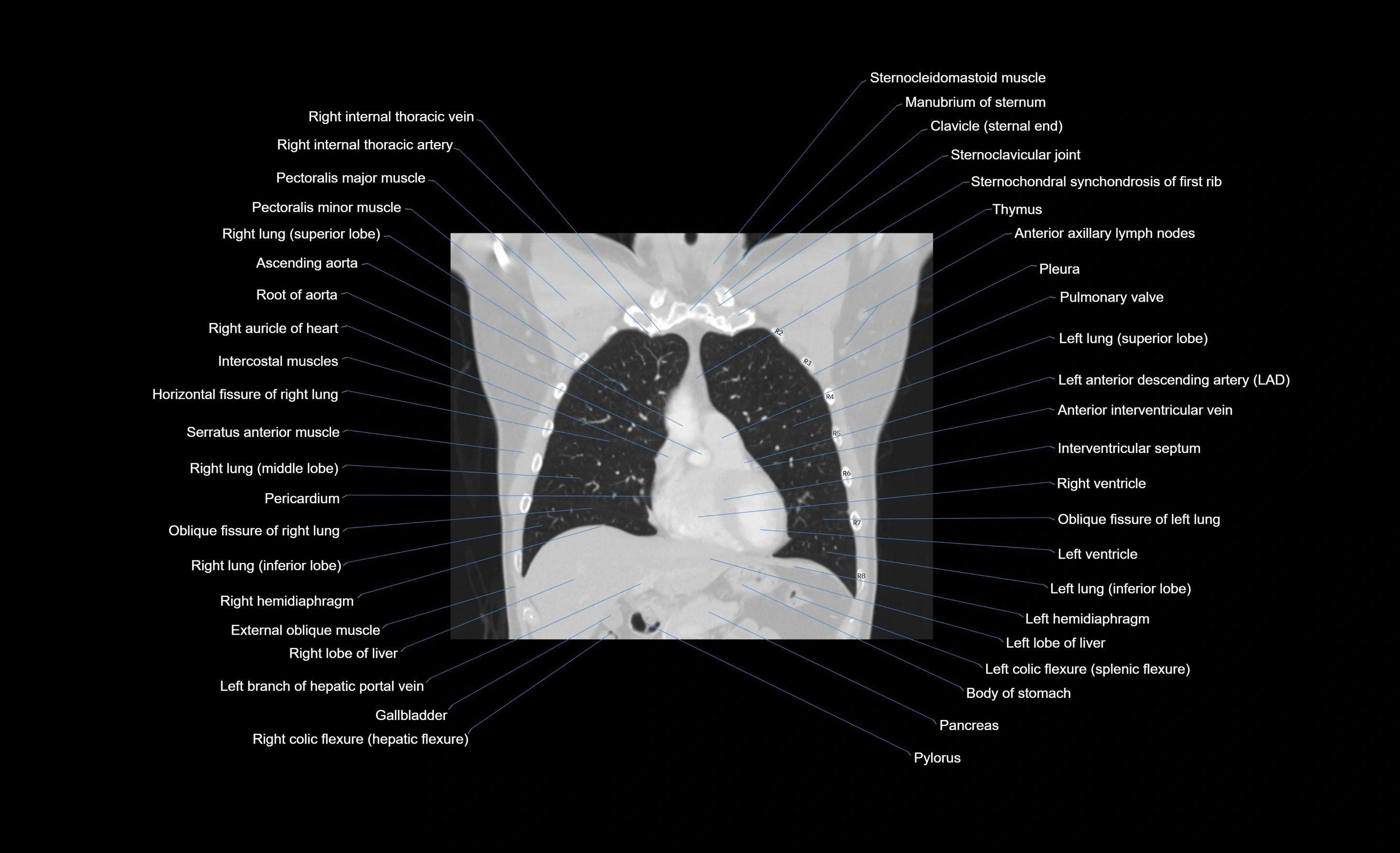 CT chest (thorax) lung window window labelled coronal cross sectional anatomy radiology image-00082.webp